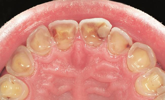 clinicl crown less thn 2 mm). This ptient required only pltl onlys. No further tretment ws necessry to restore the mxillry nterior teeth. e tht ll teeth were vitl nd mintined vitlity fter tretment.