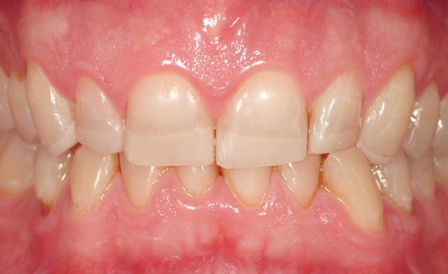 (highly experimentl) Ptients t this stge present severely compromised dentition (Fig 8).