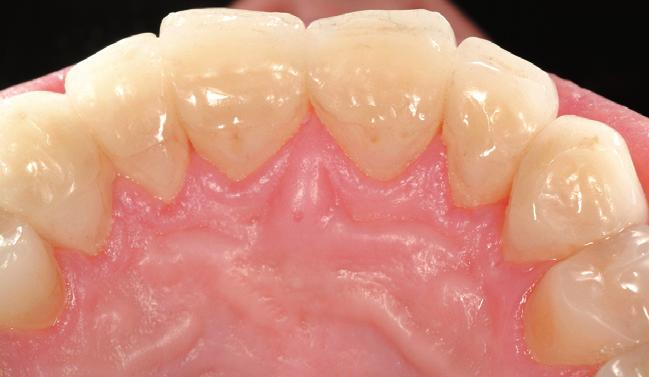 The dentl tissue destruction in this ptient ws so severe tht two teeth were not vitl t the time of the first consulttion.