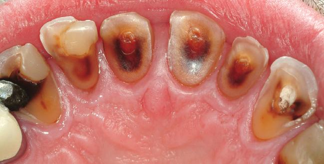 The sndwich pproch hs the dvntge of preserving the mximum tooth structure nd, in most cses, the tooth vitlity of the remining teeth.
