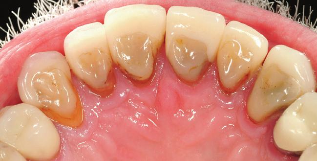 If loss of vitlity occurs s result of the severely ffected pulp of these teeth, endodontic ccess will e mde esier through the pltl veneer without