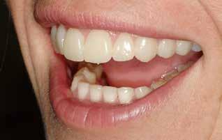 Thus, ee wxing the occlusl surfces of the posterior teeth, it is mndtory to confirm with the ptient the choice of longer nterior teeth to hrmonize the new occlusl plne.