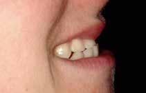 CLINICAL RESEARCH VDO is more restricted the risk of set c Fig 6 to c A 23-yer-old ptient ffected severe dentl erosion.