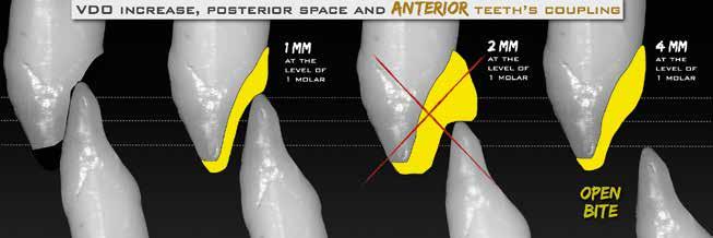 VAILATI/CARCIOFO ting the nterior teeth too fr prt thn the ptient s poor dptility to the increse of the VDO.
