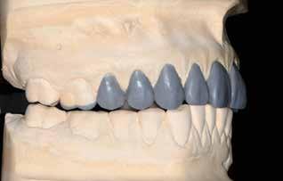 mndiulr teeth, the increse of the VDO should e determined first.