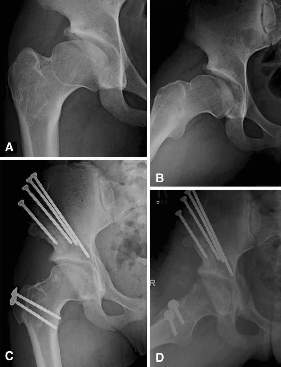 Volume 473, Number 4, April 2015 Surgical Dislocation and PAO 1373 Table 1.