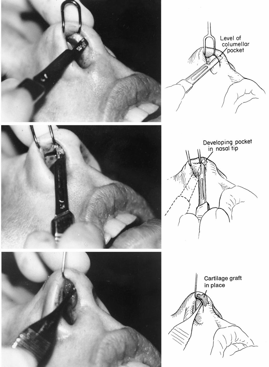 1828 PLASTIC AND RECONSTRUCTIVE SURGERY, April 2000 FIG. 10. (Above) Original tip graft technique. Opening incision at the columellarlobular junction.