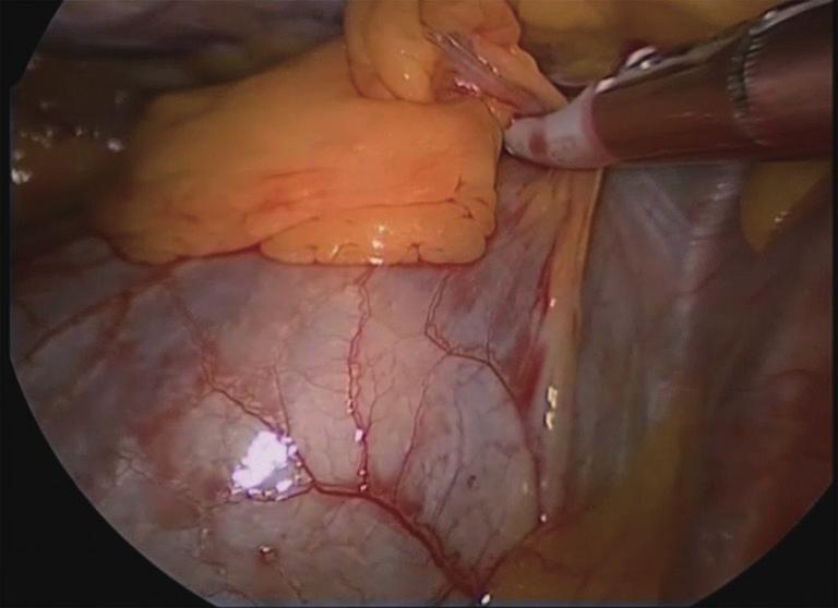 A 10 mm trocar is placed in the 5 th intercostal space on the mid-axillary line, a second 5-mm port is placed anteriorly in the inframammary fold, and the last port is placed in the 3 rd intercostal