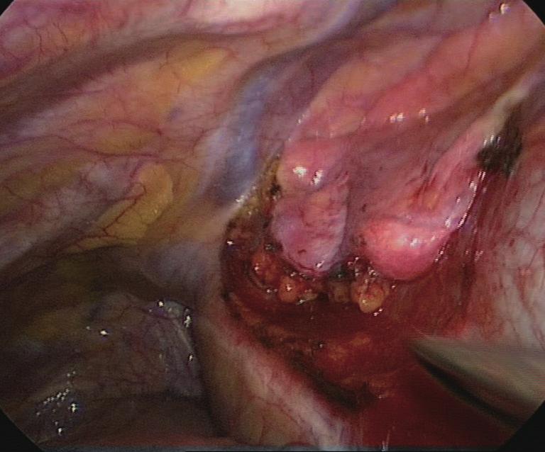 Occasionally, with larger tumors, the maneuvers may be facilitated by inserting a suction-irrigation tube operated by the assistant through a supplementary 5-mm port in the 7 th or 8 th intercostal