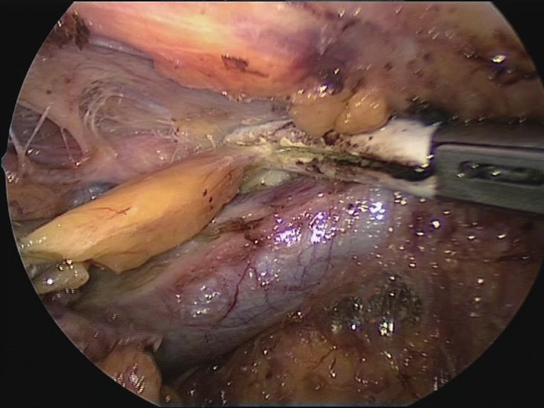 Journal of Visualized Surgery, 2017 Page 5 of 8 Figure 7 The left cervical horn of the thymus is being dissected in the neck above the left innominate vein and pulled down.