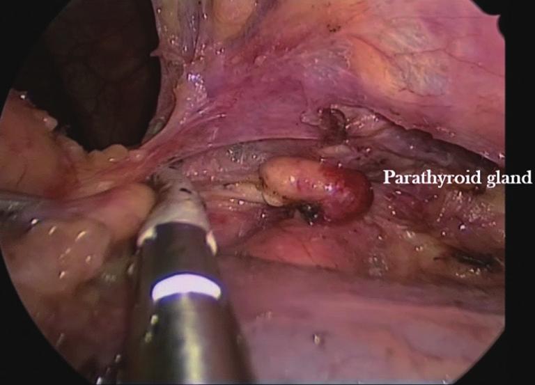 Figure 8 The right cervical horn of the thymus is being dissected in the neck above the left innominate vein (bottom of the picture) and is pulled down in a patient who had previously undergone