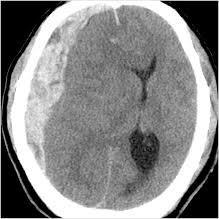 Neurological Status Alteration in mental status Delirium Dementia Traumatic Brain Injury Organ failure leading to