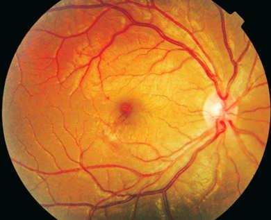 Ocular Disease 75% Bilateral May be Serotype