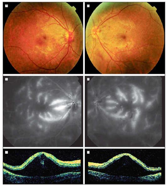 retinal detachment Choroiditis (ICGA)