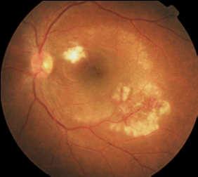 occlusion Retinitis Neuroretinitis Serous retinal