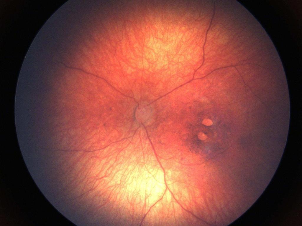 RPE Alterations Atrophic Lesions Optic Disc Hypoplasia -