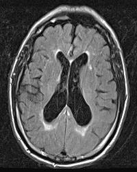 White matter signal Periventricular signal Supportive feature in 2005