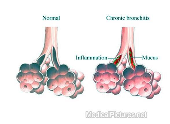 PATHOGENESIS: Chronic bronchitis, like emphysema is caused mainly by smoking.
