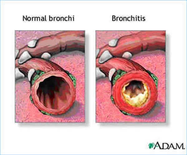 4) is increased in chronic bronchitis, usually in proportion to the severity and duration of the disease.
