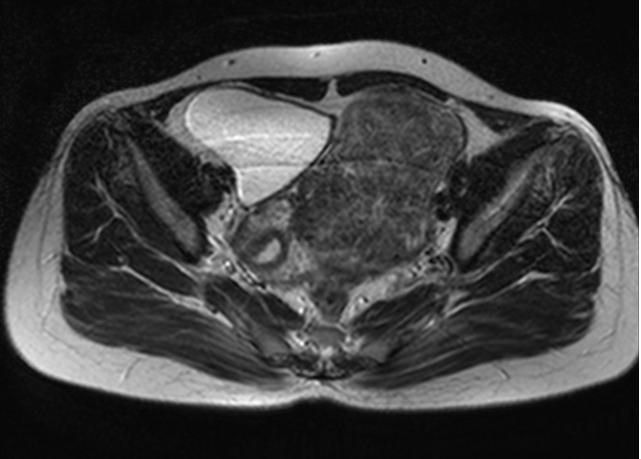 Figure 1. MRI axial T2 W images of Broad ligament fibroid.