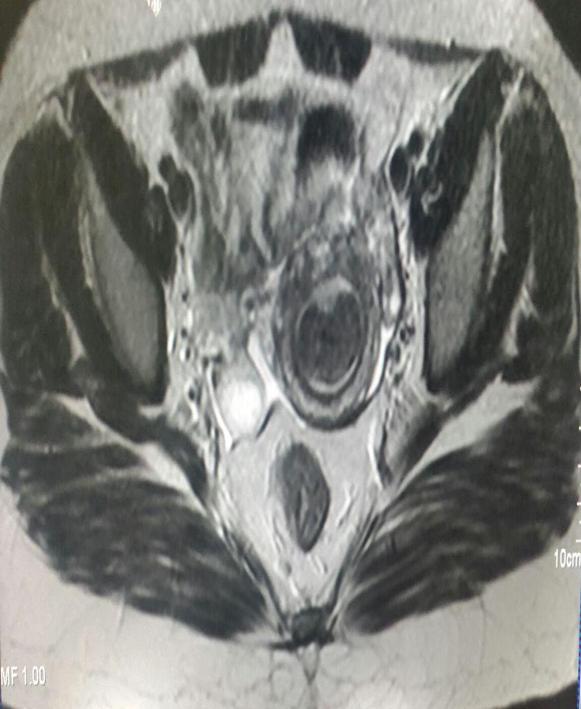 and displacing the uterus towards the right side. Figure 3. MRI coronal T2 W image of endometrial carcinoma.