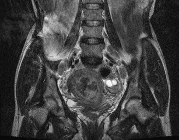 focally invading the myometrium. Also multiple enlarged bilateral common iliac lymph nodes seen. Figure 2.