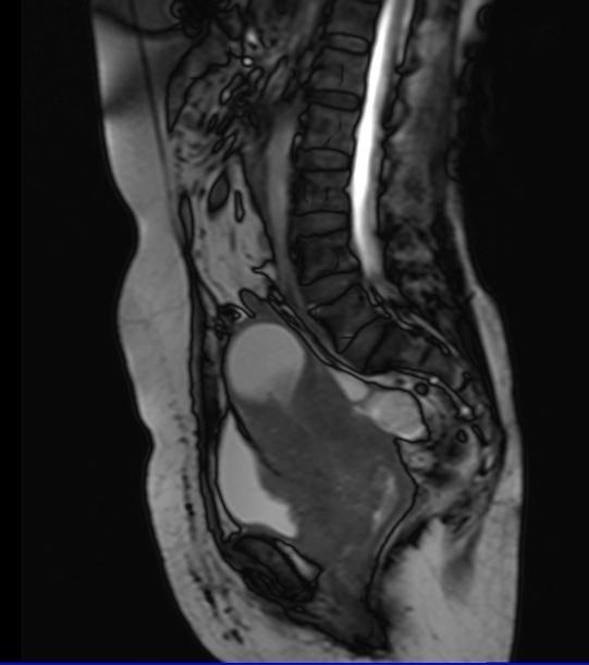 Showing a well marginated typically hypointense lesion within the endometrial cavity. Figure 4.