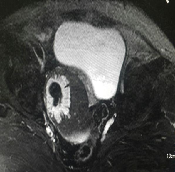 Figure 5. MRI saggital T2 W image of malignant ovarian mass lesion.