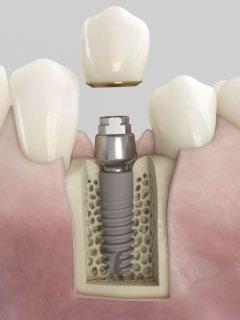 Acuris conometric concept Acuris conometric concept Acuris is a paradigm shift in prosthetic retention of fixed single crowns, yet retrievable by the