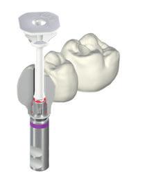 It supports a fast and simple cementation