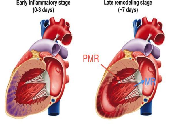 Mechanical complications of myocardial infarction Fatality as a result of MI usually from fatal arrhythmias and rarely by mechanical complications like papillary muscle rupture Anterior papillary