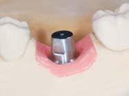 Excellent Solid Abutment Step6 Wax up Excellent Solid burn-out