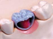 perform the wax-up procedure for the occlusal surface and resin