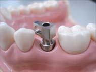 Crowns with the ComOcta abutment system Case: #35 ComOcta abutment Step1 Separating the Healing abutment Components & instruments Step2 Connecting the impression coping Impression system Short