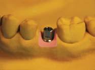 working model Select an abutment that is appropriate for the space of implant platform and antagonist