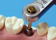 Option A : Cement retained crown ComOcta abutment Step6 From wax up to porcelain build-up