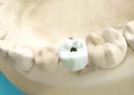 caused by the occlusal surface hole.