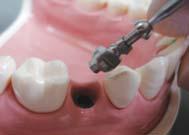 Cement retained crownwith the ComOcta Plus abutment system Case: #45 ComOcta Plus abutment Step1 Separating the Healing abutment
