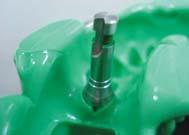 ComOcta Plus abutment Step3 Taking the impression & fabricating the working model