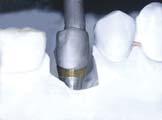 the oral cavity, tighten the abutment using a 1.