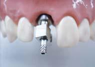 Cement retained crown with the ComOcta Angled abutment system Case: #11 ComOcta Angled