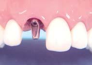 cavity Tightening the abutment with 30Ncm * Important: tightening torque =