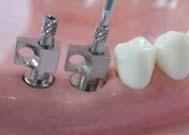 Screw retained crown with the ComOcta Gold abutment system Case:#46, 47 ComOcta Gold Abutment Step1 Separating the Healing abutment Components & instruments