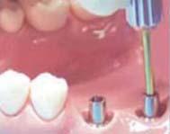 Cement-retained bridges with the Solid abutment system (non-modified abutment) Case: #36, 37 Solid Abutment Step1