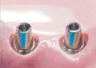 2 Hex torque driver for Solid abutment: wide Short Long Separate the cover screw or Healing abutment using a 1.