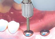 Bring the abutment to the mouth with the appropriate driver and insert it into the implant.