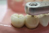 2 Hex torque driver Remove the Healing abutment or temporary crown mounted inside the oral cavity.