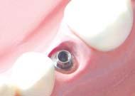 Healing abutment Short Long Separate the Cover screw or Healing abutment using a 1.2 hex hand driver.