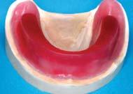 Make a base plate and a wax occlusal rim to take the occlusion for
