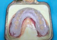 Once the fit on the wax denture inside the oral cavity is completed, construct the final resin